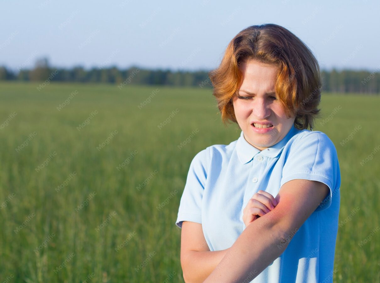Alergia na słońce, Uczulenie na słońce, biorezonans futuramedica.com.pl